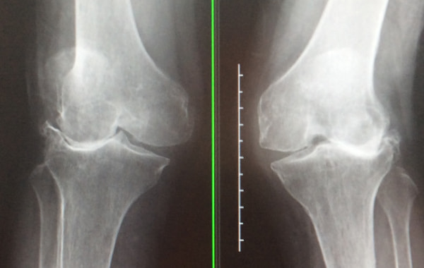 レントゲンについて