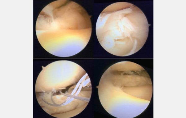 関節鏡検査について