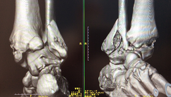 CT検査について